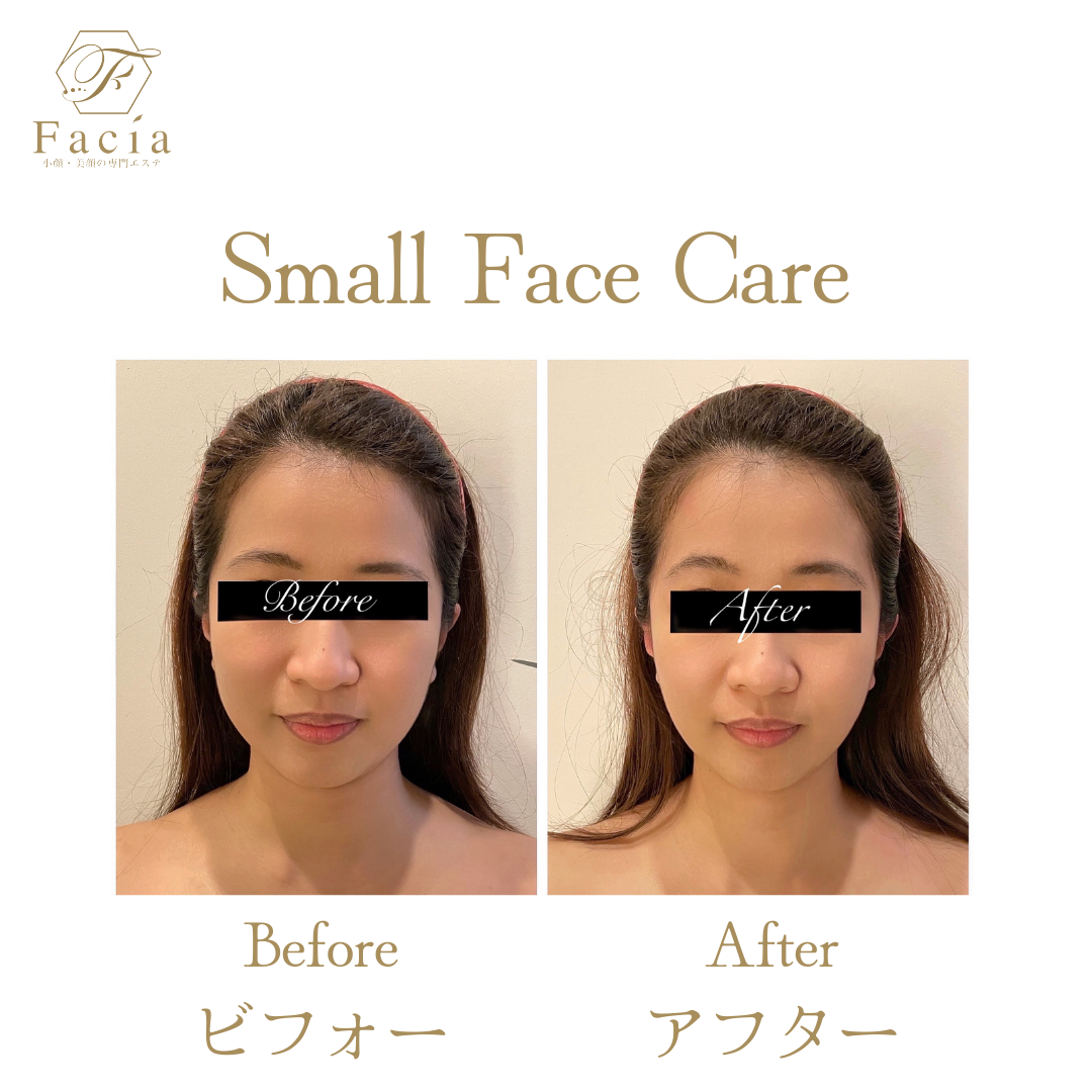 Before and after pictures of the Small Face Care treatment 