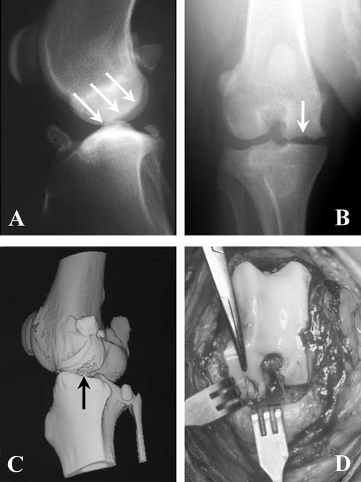 A series of images illustrating OCD of the femoral condyle
