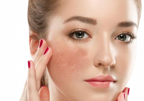 Điều trị da nám chuyên sâu, tàn nhang đốm nâu kết hợp sóng siêu âm ELIGHT