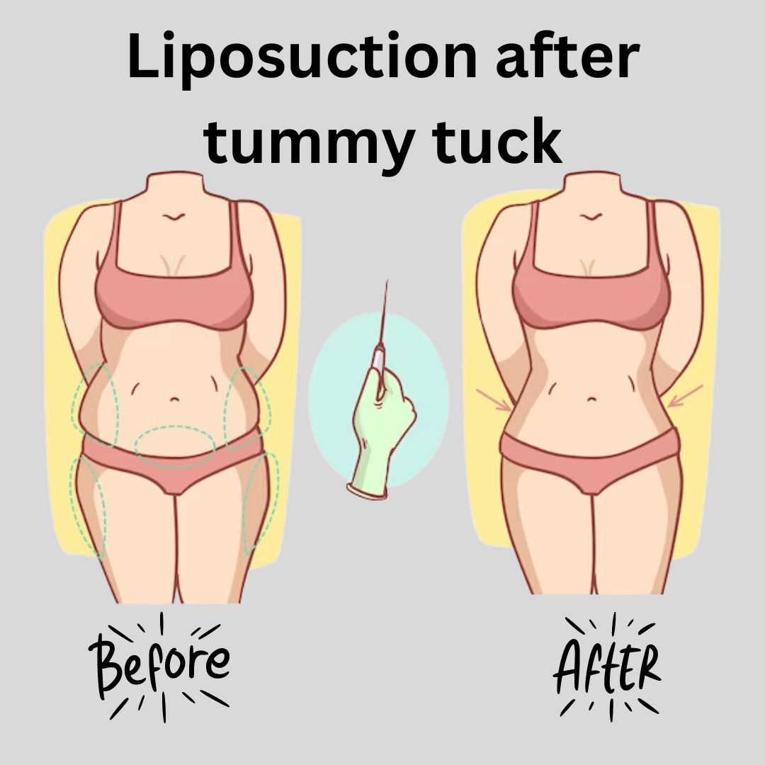 liposuction after tummy tuck