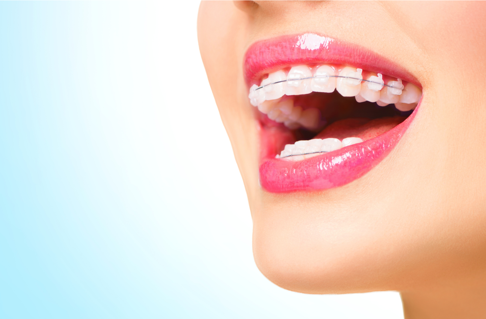 woman smiling with an open mouth showing her traditional braces with clear brackets