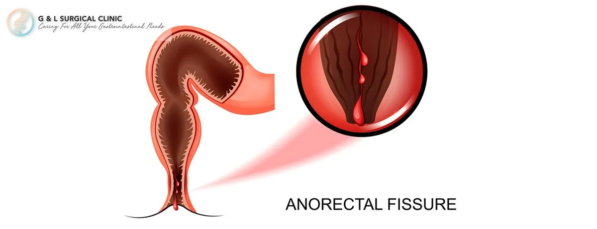 5 Frequently Asked Questions About Rectal Bleeding - G & L Surgical