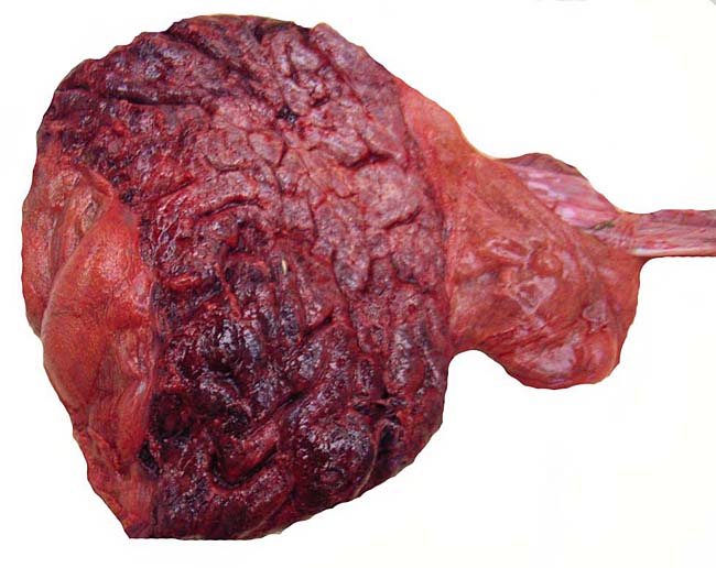 The zonary nature of this placenta