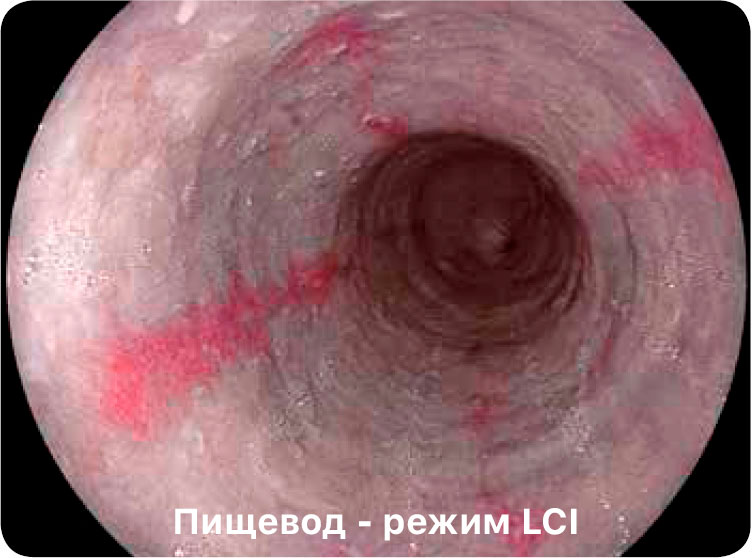 Пищевод — Режим LCI