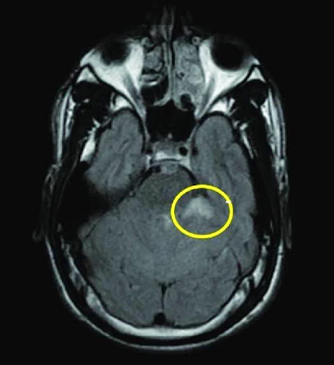 AVC de fossa posterior.