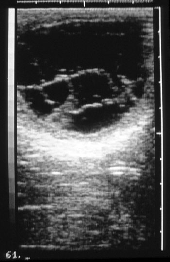 Ultrasound photo of a persistent anovulatory follicle with echogenic strands traversing the follicular lumen. The strands may be fibrin tags scattered throughout the follicular lumen.
