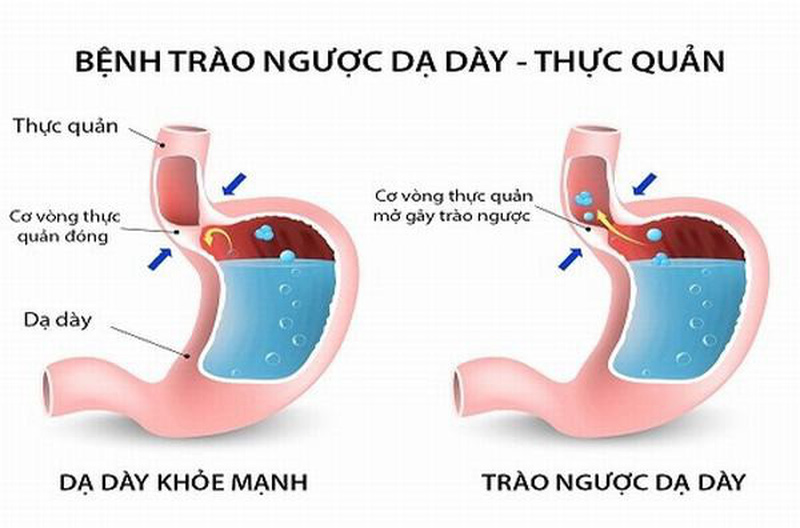 Nguyên nhân của trào ngược dạ dày thực quản