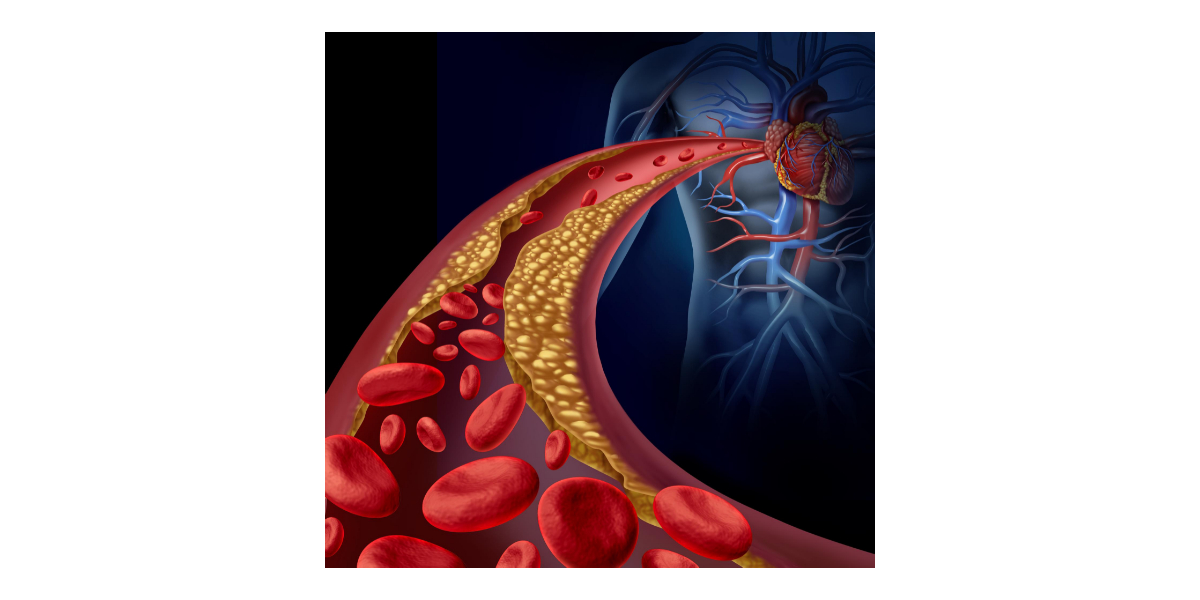 Zwiększone stężenia cholesterolu we krwi korelują z większą zachorowalnością na choroby układu krążenia