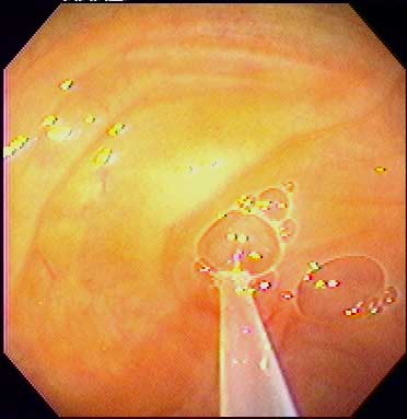 Hysteroscopic view of the UTJ and insemination catheter after insemination
