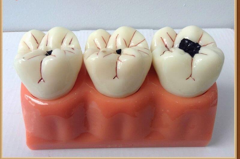 Sâu ngà răng xuất hiện những lỗ sâu màu đen trên bề mặt răng