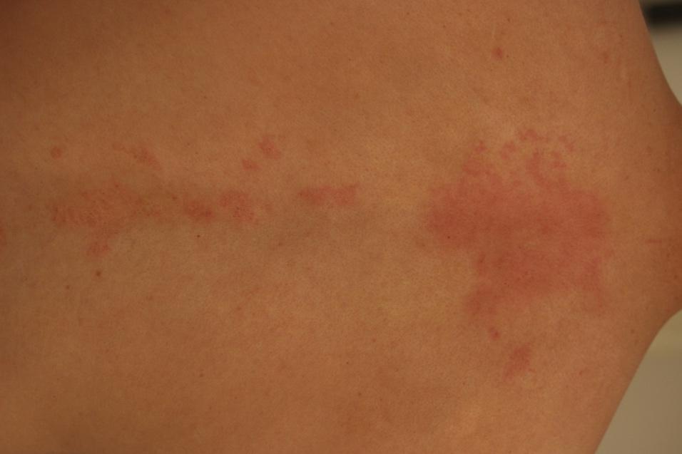 A close-up of a skin rash

Description automatically generated with low confidence