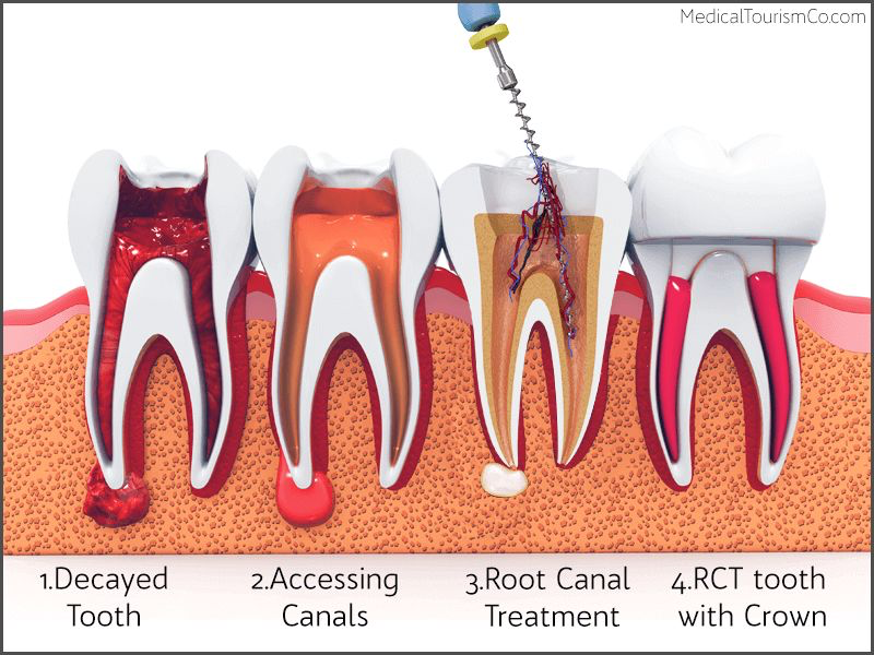 Root Canal Treatment - The Dental Bond