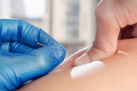 Unveiling the Benefits of Dry Needling
