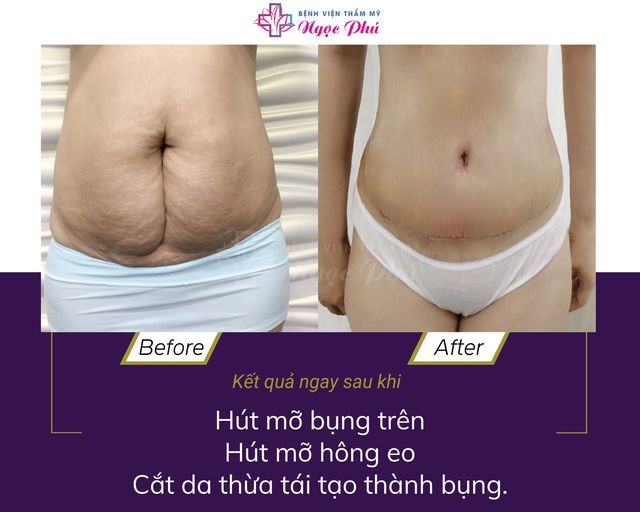 Hình ảnh khách hàng trước và sau khi hút mỡ bụng tại Phẫu thuật Thẩm mỹ Ngọc Phú