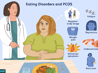 Eating Disorders and Women With PCOS