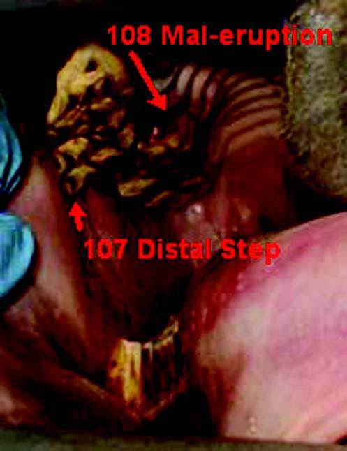 The distal aspect of 107 develops into a step as 108 mal-erupts.