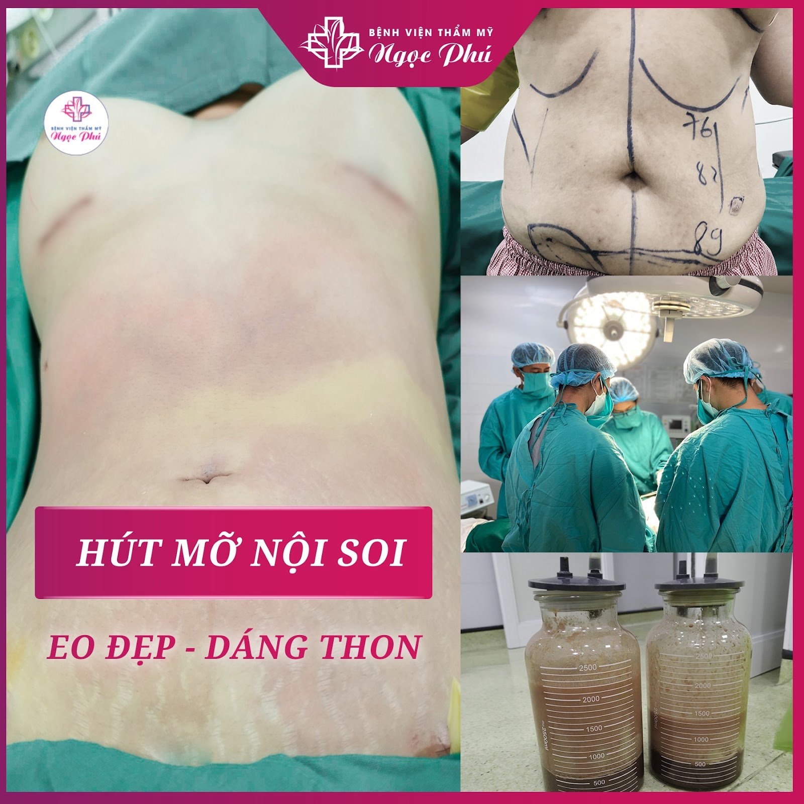 Hình ảnh khách hàng trước và sau khi hút mỡ tại Bệnh viện Thẩm mỹ Ngọc Phú