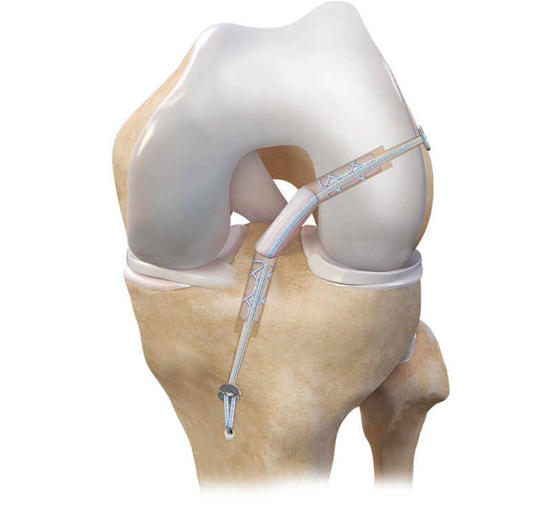 acl_reconstruction