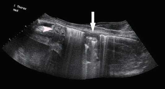 An extended field of view sonogram of a pulmonary abscess obtained from the right side of the thorax in a horse with a pulmonary abscess.