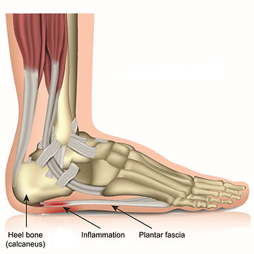 Side view of foot show plantar fasciitis