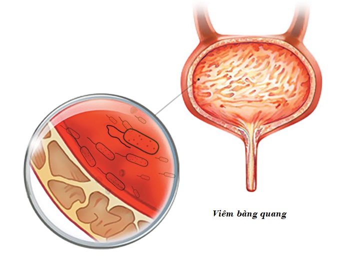 Viêm bàng quang là bệnh nhiễm khuẩn tiết niệu khá phổ biến