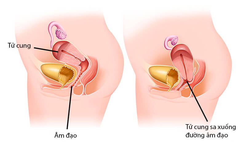 Hiệu quả và độ an toàn của thuốc điều trị sa tử cung đã được nghiên cứu và chứng minh như thế nào?