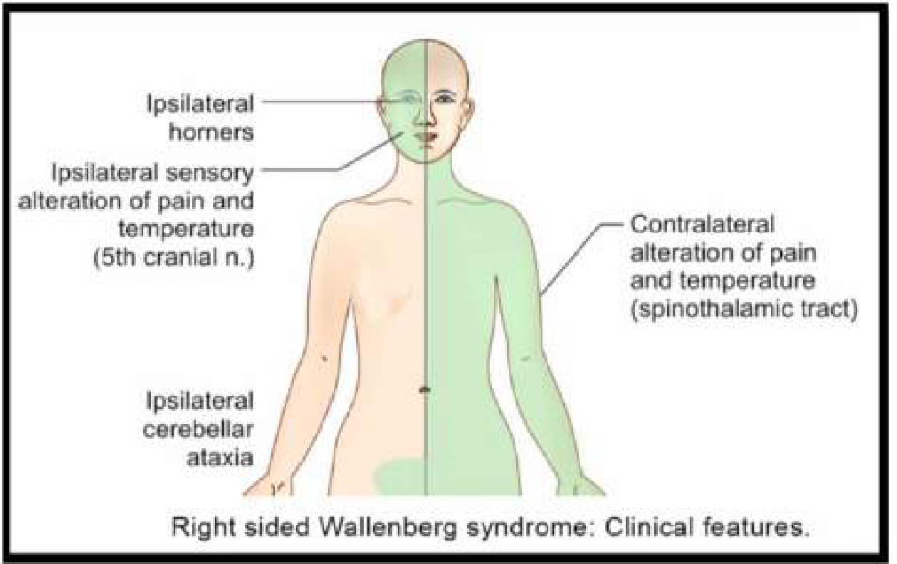 WALLENBERG SYNDROME    