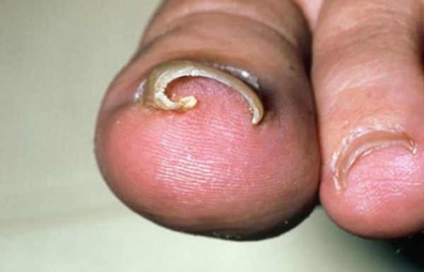 Lấy khóe móng chân nhiều có tác hại gì?
