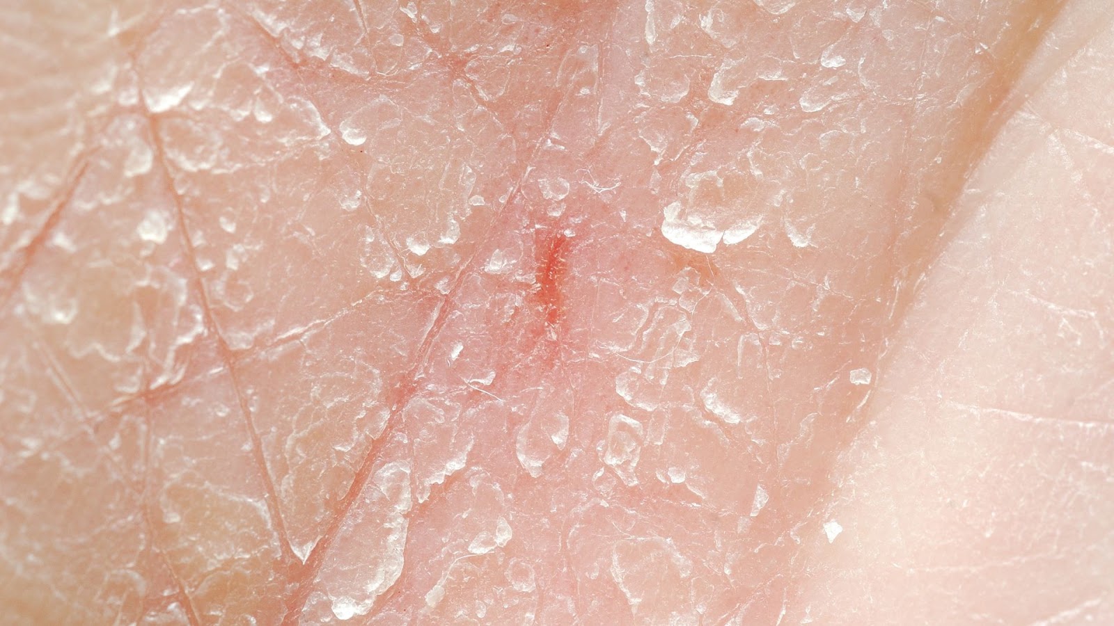 A patch of very dry skin.