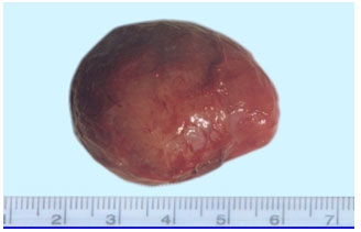  A fibroma recovered from an abattoir derived buffalo uterus.