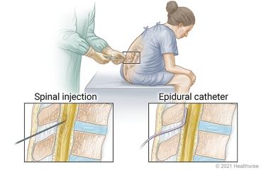 Spinal and Epidural Anesthesia