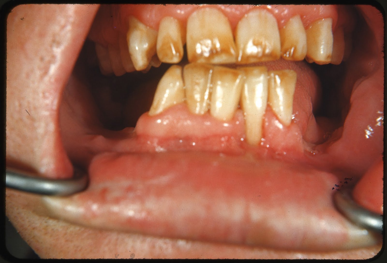 FLUOROSIS DENTAL: INTRODUCCI\u00d3N