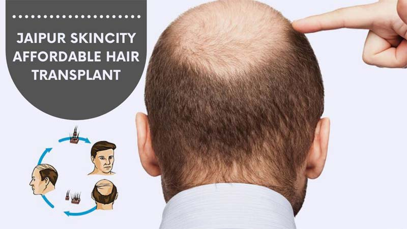How Much Do Hair Transplants Cost?