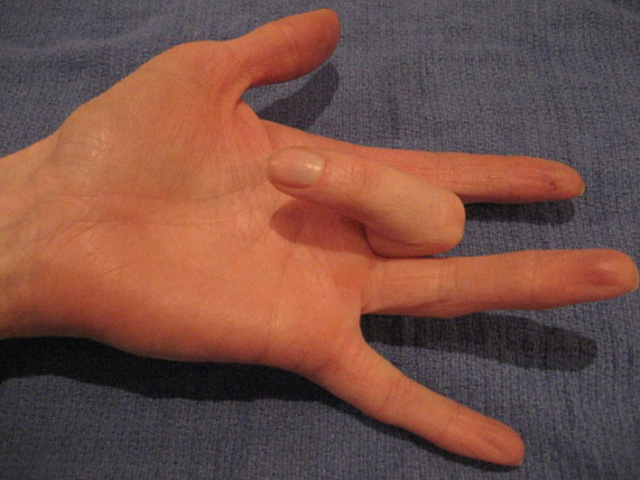 Hình ảnh đặc trưng của bệnh ngón tay lò xo