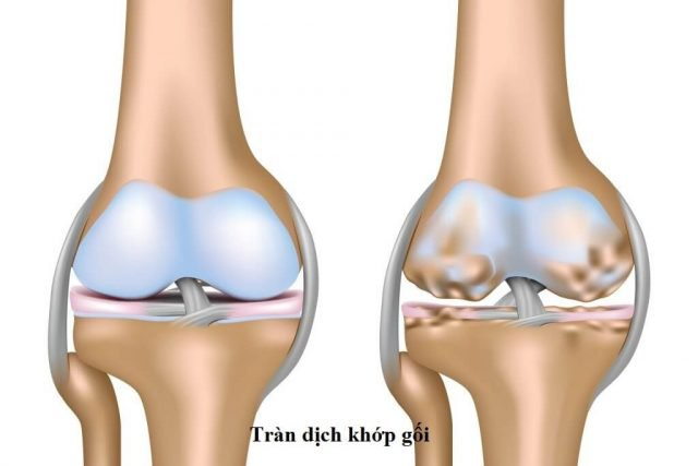 thuốc đắp chữa tràn dịch khớp gối
