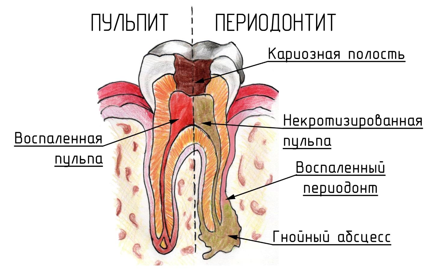 Особенности периодонтита зубов