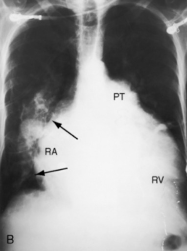 Aumento das câmaras cardíacas direitas (átrio direito - RA; e ventrículo direito - RV) associado a sinais de hipertensão pulmonar com aumento do tronco da artéria pulmonar (PT).