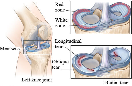 What is the quickest possible recovery time after knee surgery for a torn meniscus?