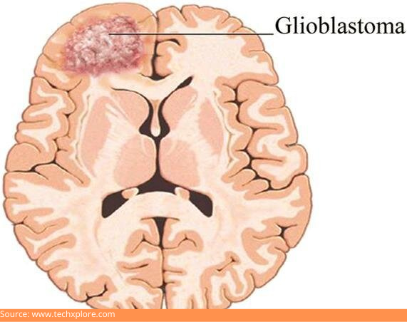 D:\Digicore\UNOSEARCH\Dr Mohana Rao Neurosurgeon Guntur\All About Glioblastoma\Source Gioblast.jpg