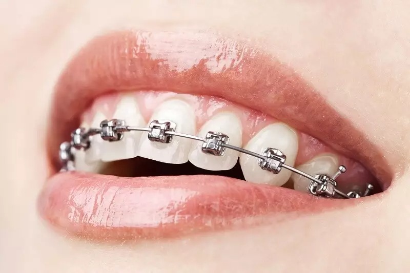 Các phương pháp niềng răng móm phổ biến hiện nay