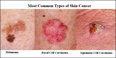 skin-cancer.jpg