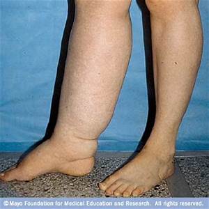 Lymphedema in the leg. Leg is swollen more than double the size of the other leg.