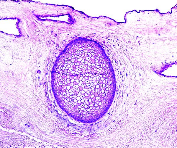 Amnion with pigmented squamous epithelial inclusion
