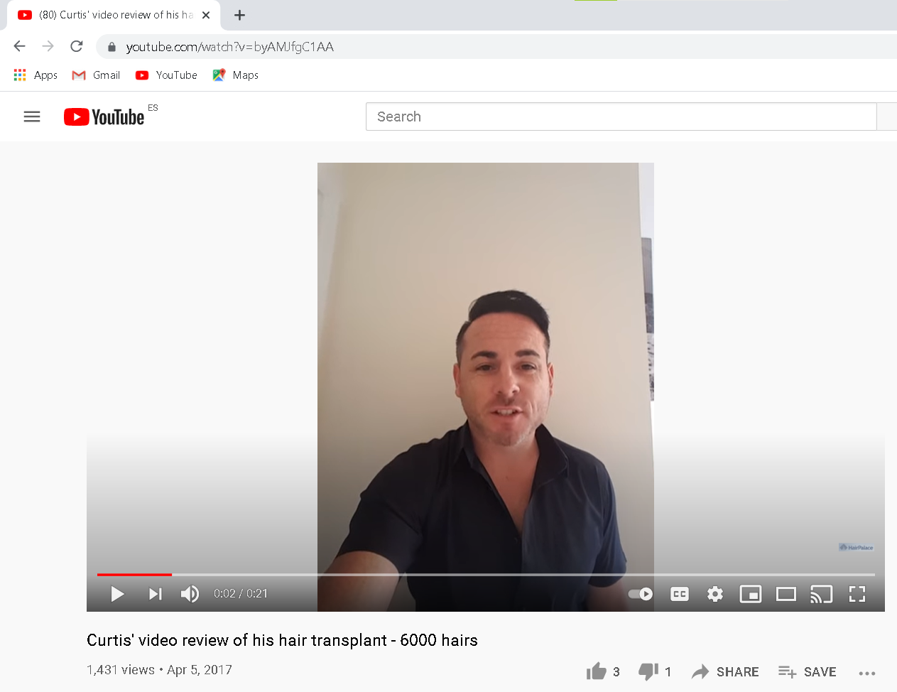video review about a hair transplant experience
