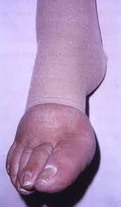 Swollen foot due to edema