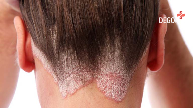  Hình ảnh trực quan về bệnh vẩy nến da đầu