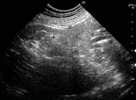 Ovarian carcinoma (presumptive)