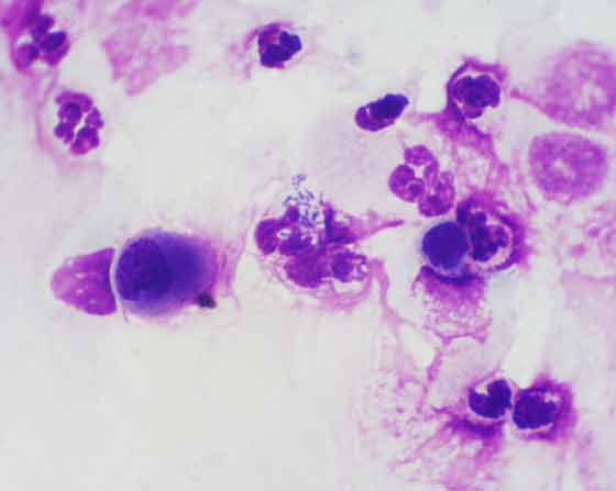 Intracellular bacteria in a neutrophil of a horse with IAD.