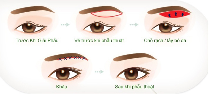 Nâng cung mày là một ca tiểu phẫu nhỏ