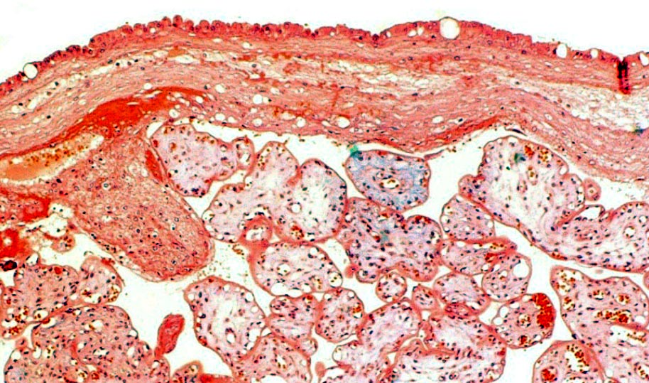 Surface of the term placenta showing the island of extravillous trophoblast at left.